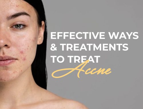 Effective ways and treatments to treat acne