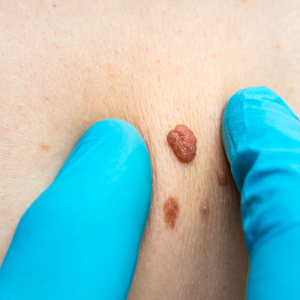 lesion, wart, and skin tag removal in London Ontario