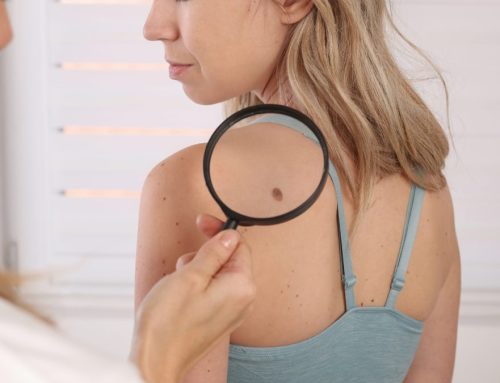 Everything You Need to Know About Skin Tags and Skin Tag Removal