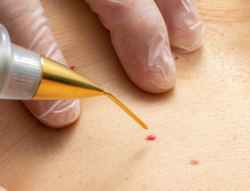 Wart and Skin Tag Removal: DIY vs. Professional