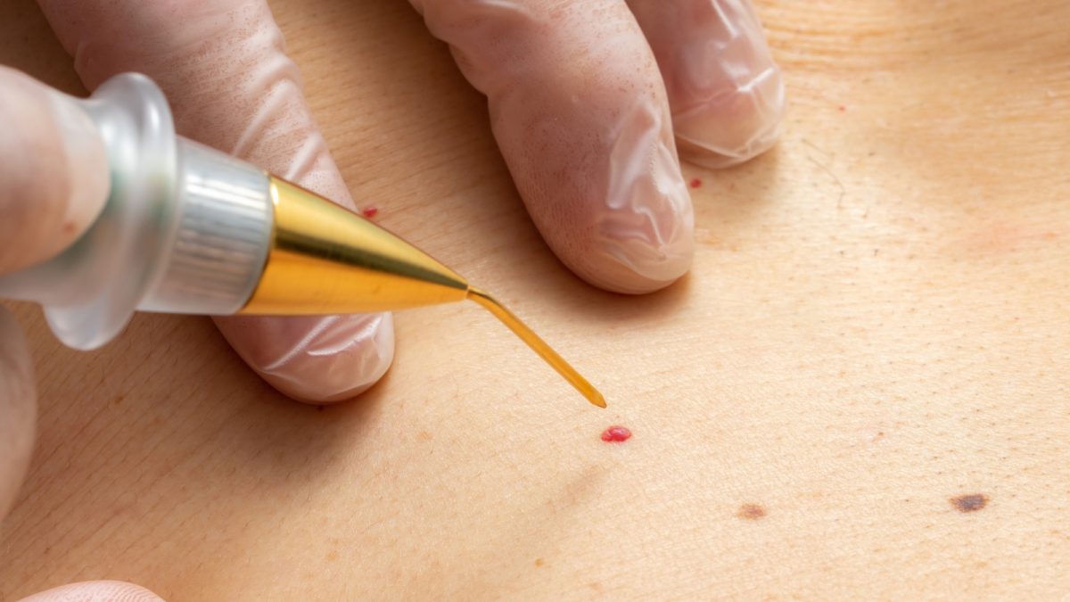 Wart and Skin Tag Removal